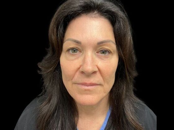 Blepharoplasty Case 3 - Before