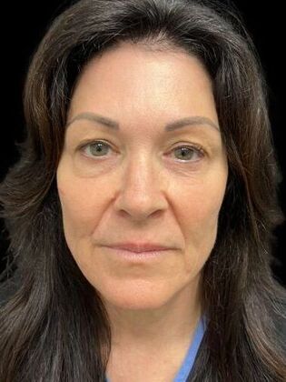 Blepharoplasty Blepharoplasty 4 - Before