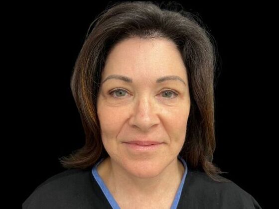 Blepharoplasty Case 3 - After