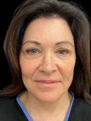 Blepharoplasty Blepharoplasty 4 - After