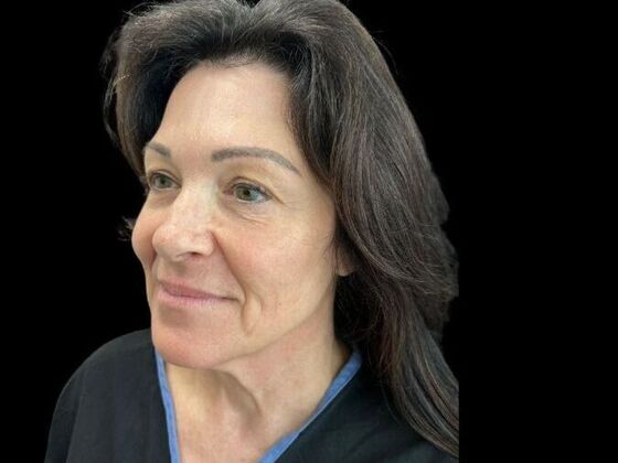 Blepharoplasty: Case 3 - Before