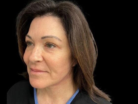 Blepharoplasty: Case 3 - After