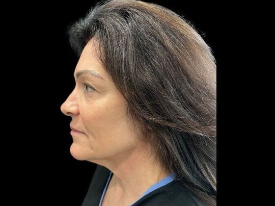 Blepharoplasty: Case 3 - Before