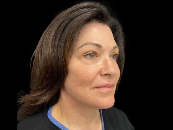 Blepharoplasty: Case 3 - Before