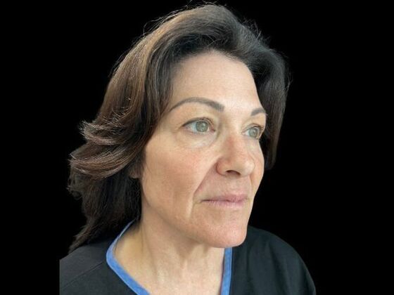 Blepharoplasty: Case 3 - After