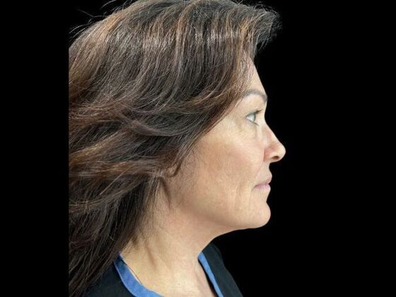 Blepharoplasty: Case 3 - Before