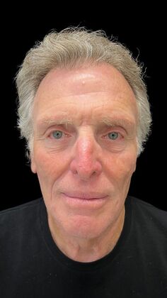 Face & Neck Lifts Case 4 - Before