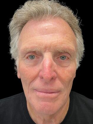Face & Neck Lifts Facelift 3 - Before