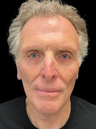 Face & Neck Lifts Facelift 3 - After