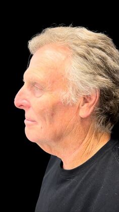 Face & Neck Lifts: Case 4 - Before