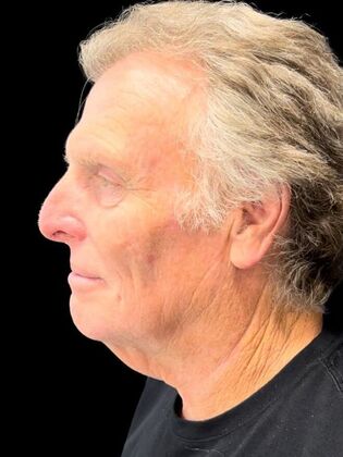 Face & Neck Lifts: Facelift 3 - Before