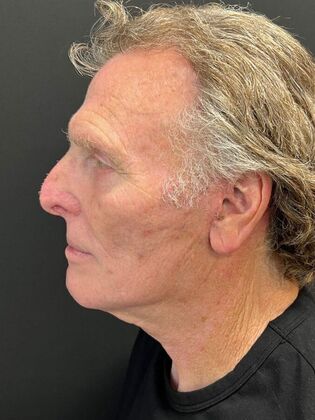 Face & Neck Lifts: Facelift 3 - After