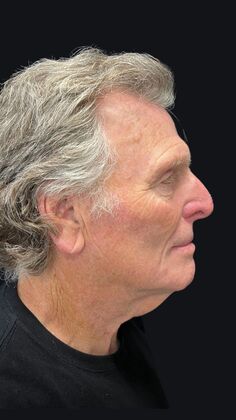 Face & Neck Lifts: Case 4 - Before