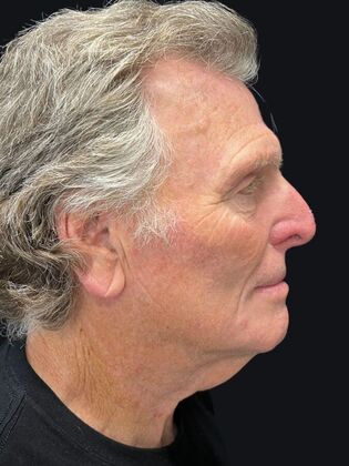 Face & Neck Lifts: Facelift 3 - Before