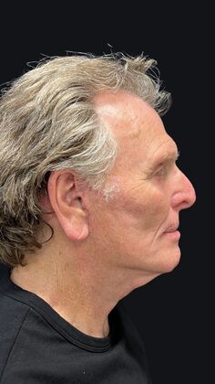 Face & Neck Lifts: Case 4 - After