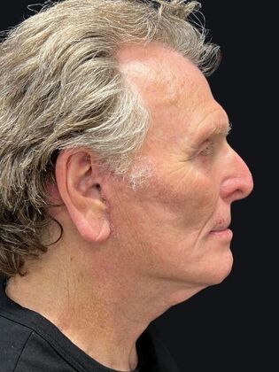 Face & Neck Lifts: Facelift 3 - After