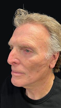 Face & Neck Lifts: Case 4 - After