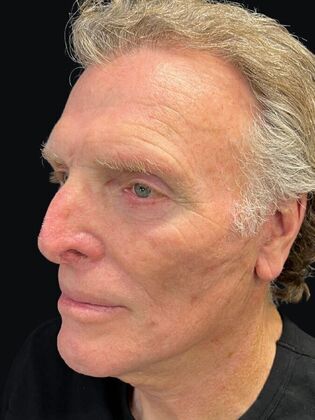 Face & Neck Lifts: Facelift 3 - After
