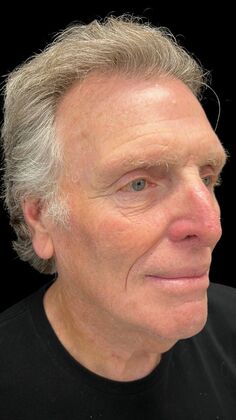Face & Neck Lifts: Case 4 - Before