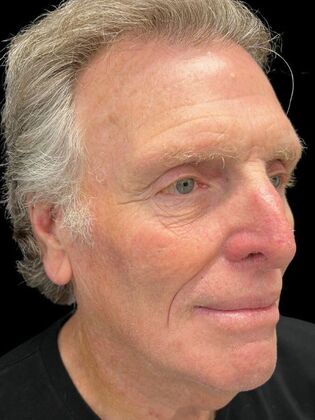 Face & Neck Lifts: Facelift 3 - Before