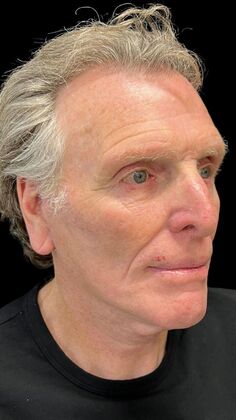 Face & Neck Lifts: Case 4 - After