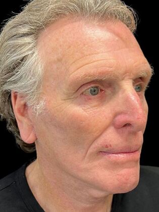 Face & Neck Lifts: Facelift 3 - After