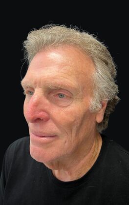 Face & Neck Lifts: Case 4 - Before