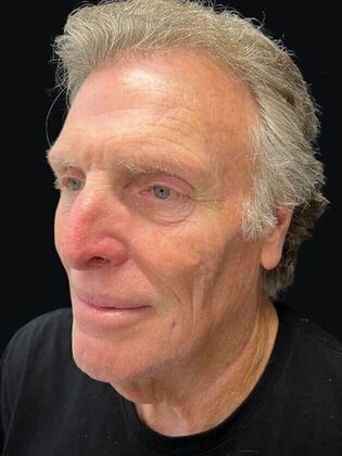 Face & Neck Lifts: Facelift 3 - Before