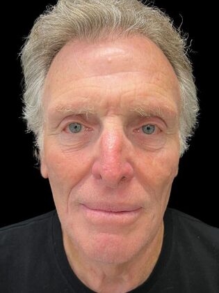 Blepharoplasty Case 5 - Before
