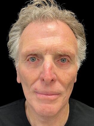 Blepharoplasty Case 5 - After