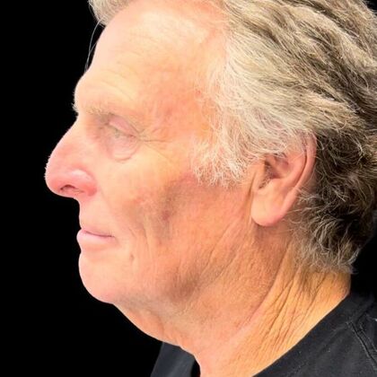 Blepharoplasty: Case 5 - Before