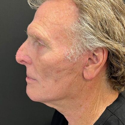 Blepharoplasty: Case 5 - After