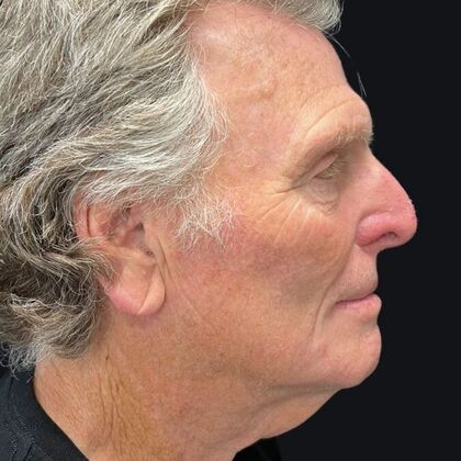 Blepharoplasty: Case 5 - Before