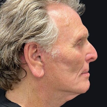 Blepharoplasty: Case 5 - After