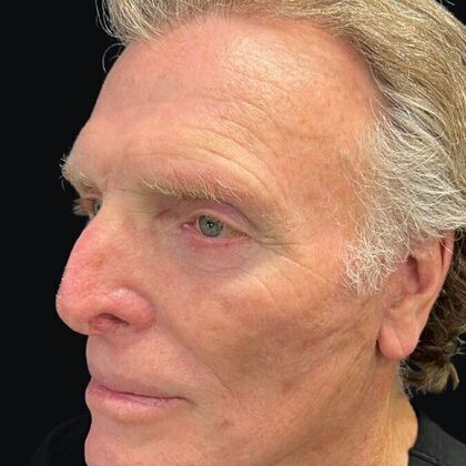 Blepharoplasty: Case 5 - After