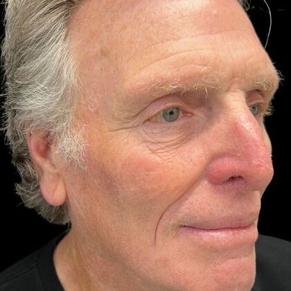 Blepharoplasty: Case 5 - After