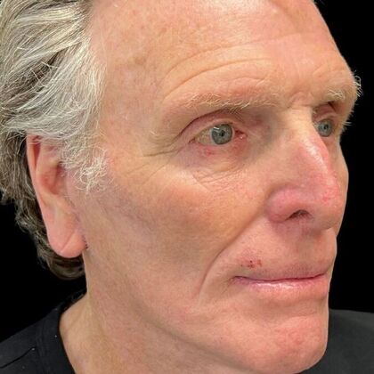 Blepharoplasty: Case 5 - After