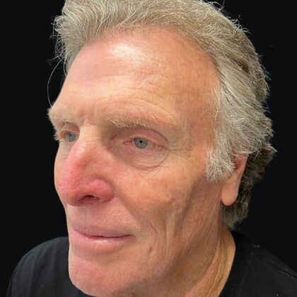 Blepharoplasty: Case 5 - Before