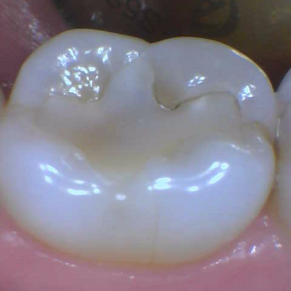 Fillings Case 1 - Before