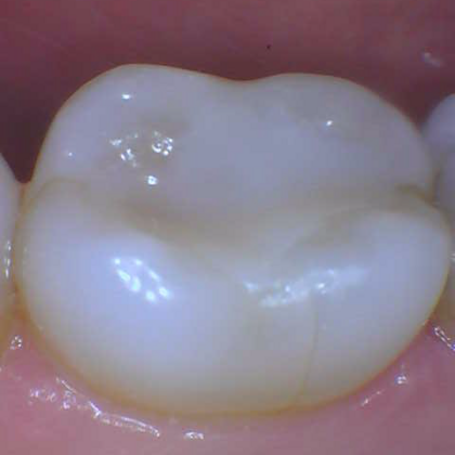 Fillings Case 1 - After