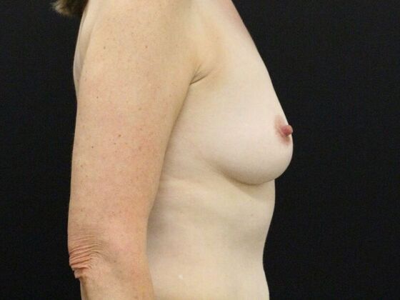 Breast Lift & Breast Lift Augmentation: Case 69 - Before