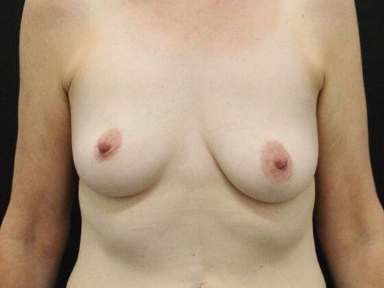 Breast Lift & Breast Lift Augmentation Case 69 - Before