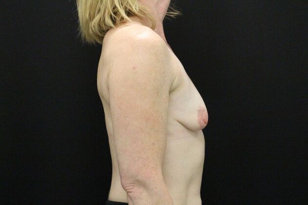 Breast Lift & Breast Lift Augmentation: Case 70 - Before