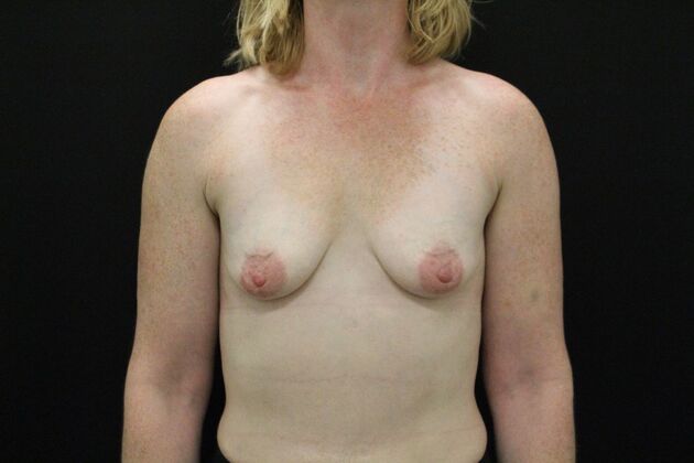 Breast Lift & Breast Lift Augmentation Case 70 - Before