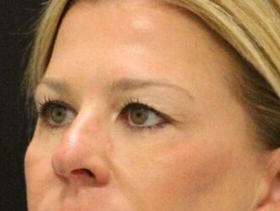 Eyelid Surgery: Case 3 - Before