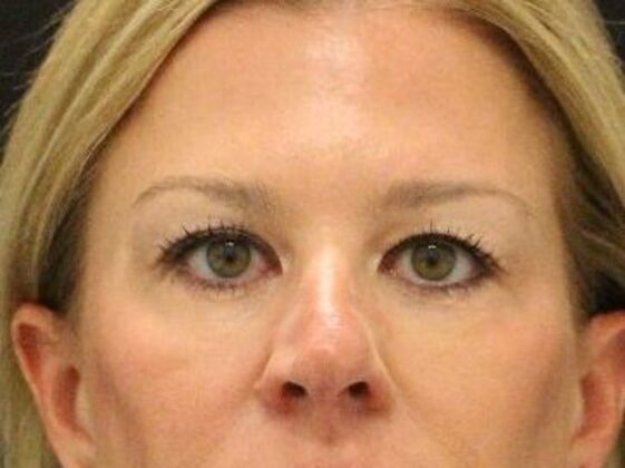 Eyelid Surgery Case 3 - Before