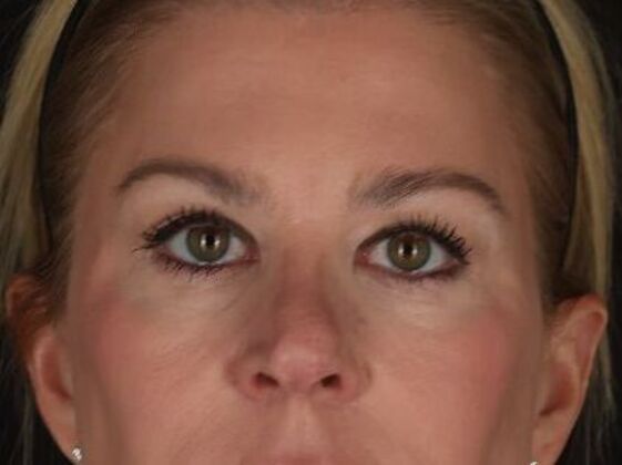 Eyelid Surgery Case 3 - After