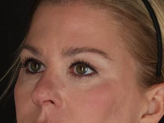 Eyelid Surgery: Case 3 - After