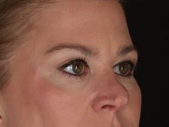 Eyelid Surgery: Case 3 - After