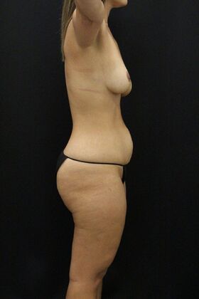 Liposuction: Case 74 - Before